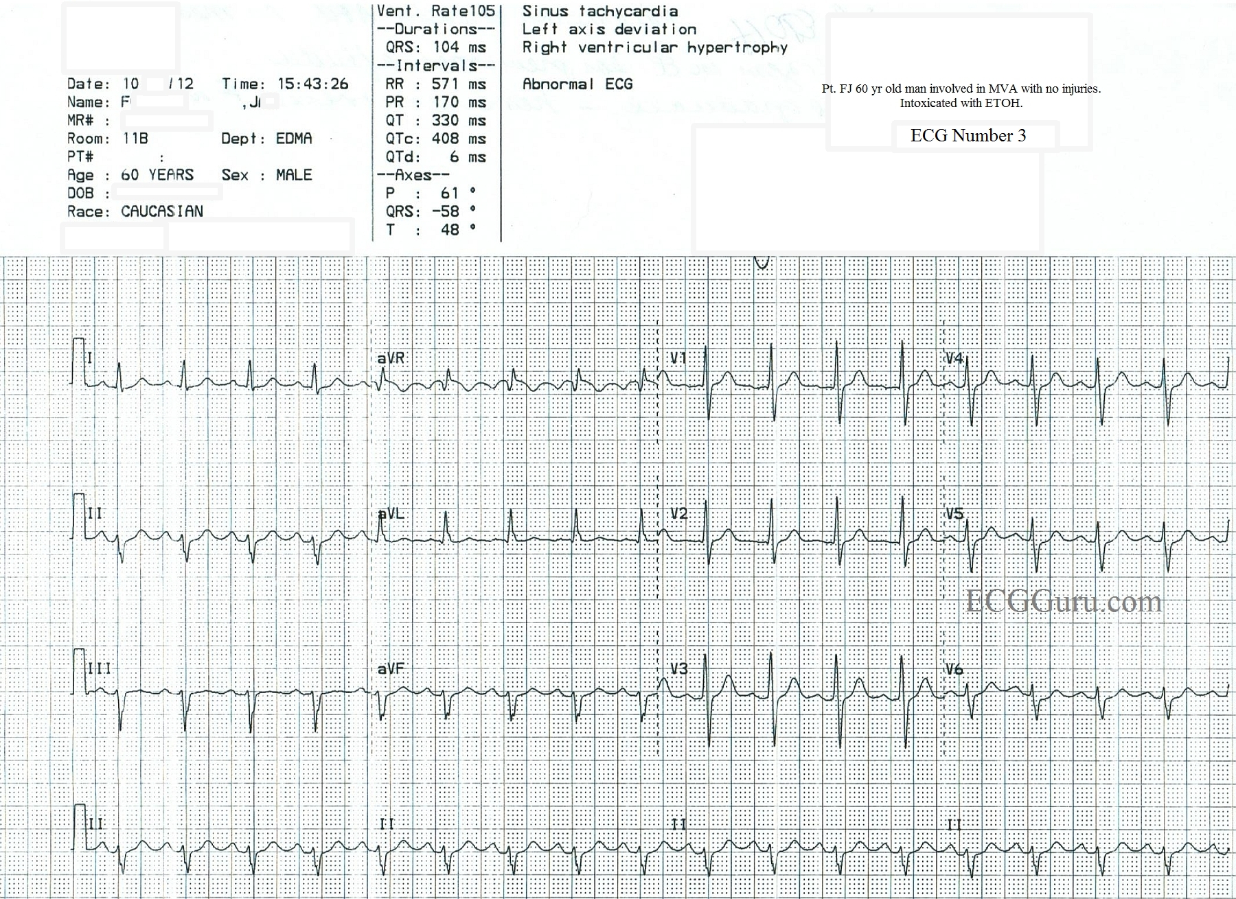 Sinus Tach vs SVT In An Inebriated Patient ECG Guru Instructor